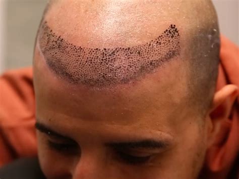 Tattooed hairline. Things To Know About Tattooed hairline. 